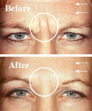 This patient had several small injections into the scowl area (circle) and forehead frown lines (arrows). The after picture was taken one week following treatment. The patient was trying to frown as much as possible in both pictures. Note the improvement in the scowl lines and the forehead frown lines.