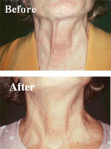 Note the improvement in the appearance of this patient’s neck after only one treatment. The ridged neck cords have flattened producing a much smoother appearance.