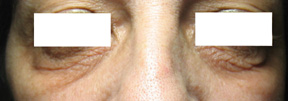 Before treatment of eye creases