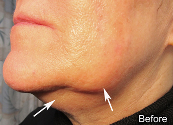 Before Kybella treatment of the double-chin and jowl areas.