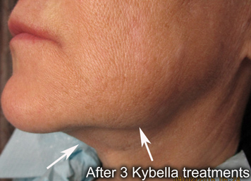 Note the improved chin and jowl appearance after 3 Kybella treatments.