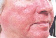 Facial redness, pre-treatment