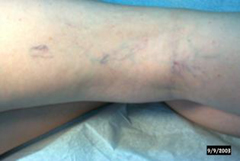 Leg veins before IPL treatment