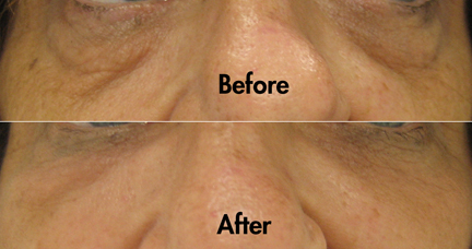 Restoration of cheek volume with improvement of the under-eye grooves