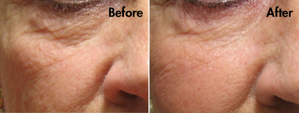 Restoration of cheek volume with improvement of under-eye-groove