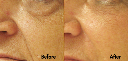 Restoration of cheek volume with improvement of under-eye groove, and smile lines