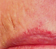 Before treatment of deep upper lip creases