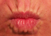 Before treatment of lip lines (patient puckering)