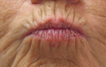 Before treatment of pucker lines