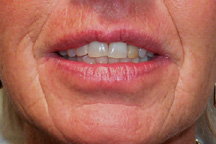 Before treatment of lips and smile lines