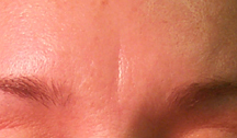 Before forehead crease treatment