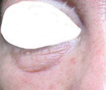 Before under eye crease treatment