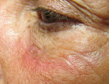 Immediately after one Restylane treatment