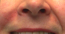 After treatment of right smile line only. Notice the deeper crease on the untreated side