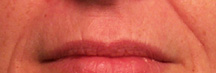 Before treatment - upper lip & smile lines