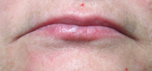 Before treatment lips